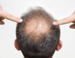 脱发严重 三个原因告诉你为啥脱发