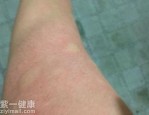 皮肤过敏瘙痒怎么办 治疗皮肤过敏先要了解过敏原