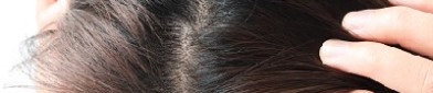 掉头发暗示5种疾病
